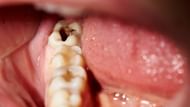 Rotten teeth (Image via Getty Images)